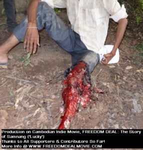 Landmine injury, appearing in 'Freedom Deal: Story of Lucky' by filmmaker Jason Rosette (as Jack RO)